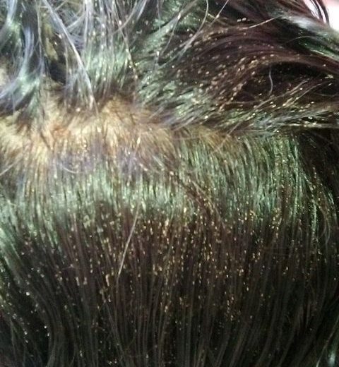 What causes lice?