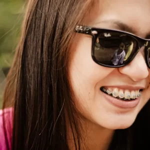 Braces Colours for Your Smile; Here Are Some Suggestions